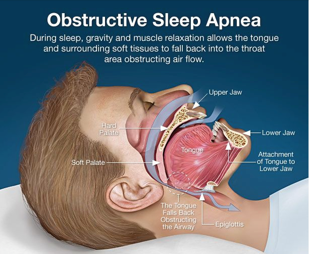 Sleep Apneia